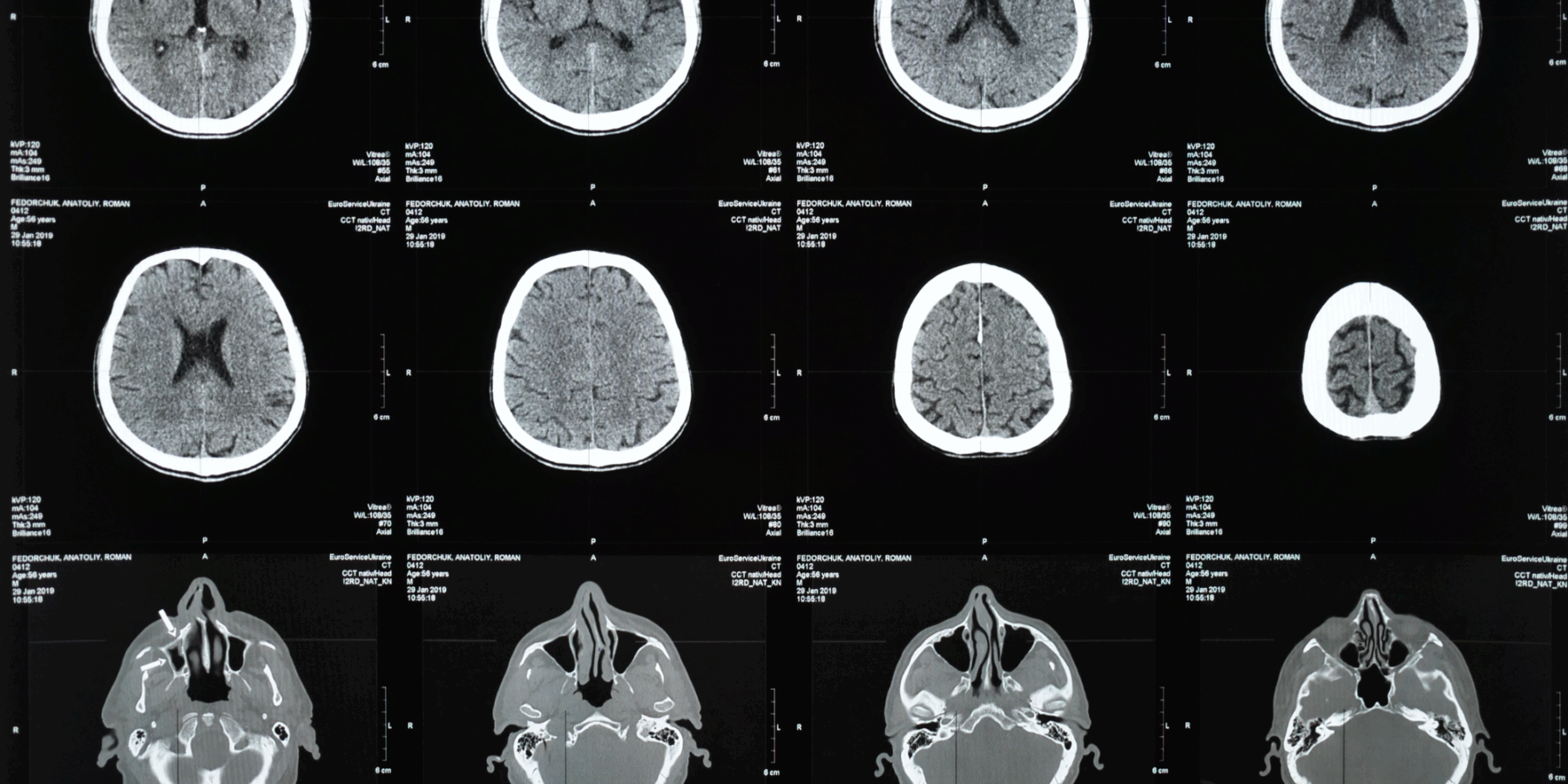 traumatic brain injury